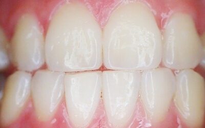 Ways to Detect and Prevent Gum Recession