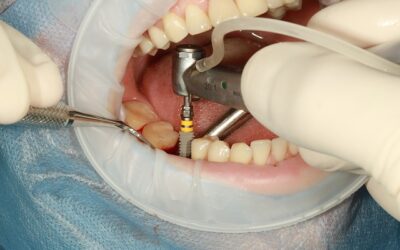 A dental implant or partial dentures. What’s better for you?
