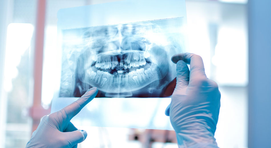 Why Do I Need a Dental X-Ray?