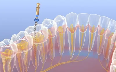 Your Questions Answered About Root Canals