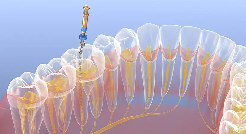 Your Questions Answered About Root Canals