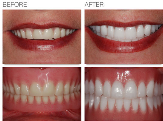 cosmetic dentures before-after