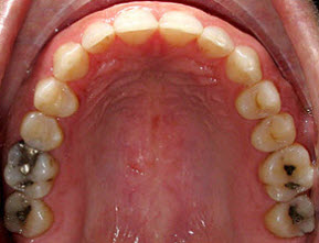 Invisalign Spaces After