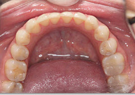 Invisalign Crowded