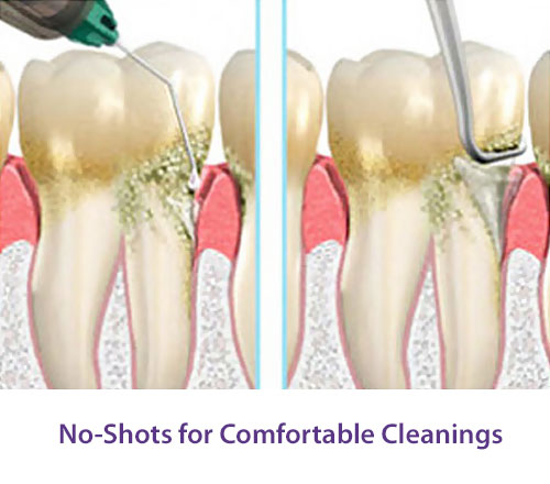 No-Shots Dental Cleanings