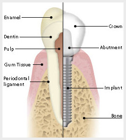 Dental Implants vs Tooth