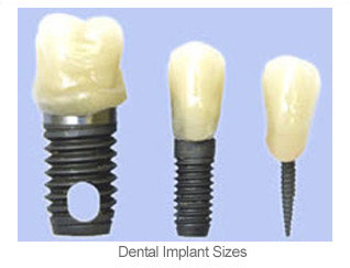 implant sizes