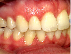 invisalign flared After