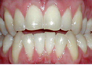 Open Bite Front Teeth - Before