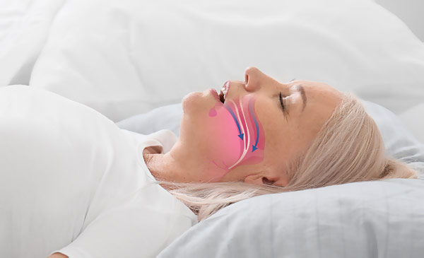sleep apnea treatment Glen Ellyn