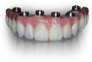 Teeth Tomorrow Implant bridge