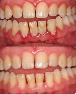 Treatment of Gum Disease