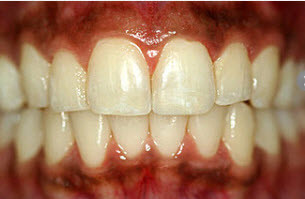 Periodontal-disease-gingivitis-A