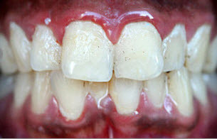 Periodontal-disease-gingivitis-B