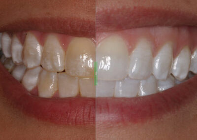 Tooth-Whitening-400x284