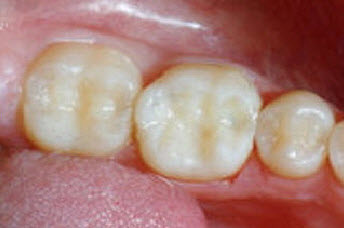 Tooth-bonding-white-fillingA