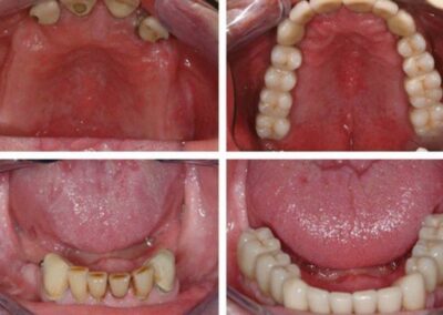 U-L-Implant-Bridges-400x284