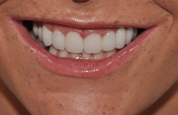 Veneers-Close-After