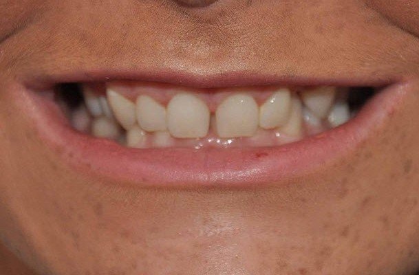 Veneers-Close-Before