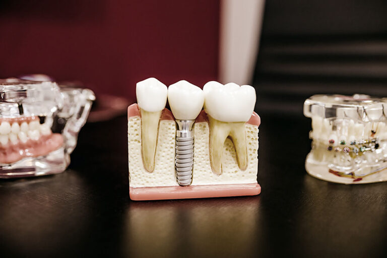 dental-implant-Glen-Ellyn, UL