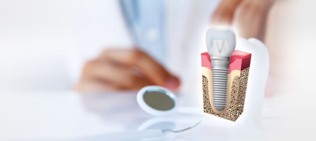 dental implants