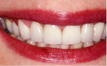 porcelain-veneers-whiteninG-A-1