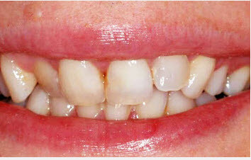 porcelain-veneers-whitening-b