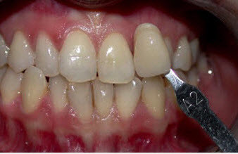 tooth-whitening-glen-ellyN-B