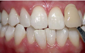 tooth-whitening-glen-ellyn-A