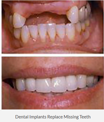 before and after dental treatment at Smile Glen Ellyn - Dentist in Glen Ellyn